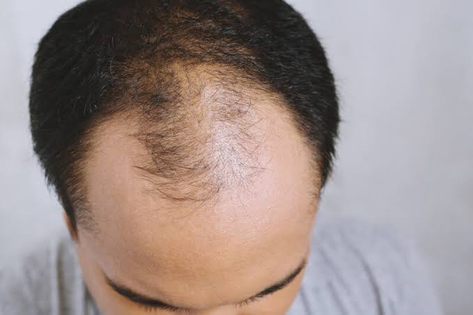 How to Regrow Hair On A Bald Spot Medically.